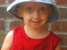 Rarología: Progeria