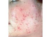 Como curar acne horas