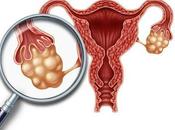 Síndrome ovárico metabólico poliendocrino