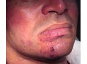 Medicina Casera para Herpes