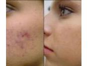 ¿Cómo eliminar acne?
