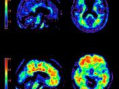 Nuevo escáner cerebral para alzheimer