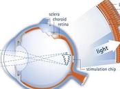 Implante electrónico devuelve vista ciegos retinosis pigmentaria