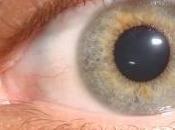 color ojos puede ayudar predecir cierta predisposición vitíligo cáncer piel