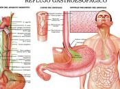 Opciones terapéuticas para enfermedad reflujo gastroesofágico