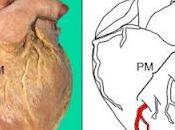 Síndrome ordenamiento coronario, puente intramiocárdico “milking”