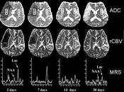 Leucoaraiosis afecta función cerebral Adulto Mayor