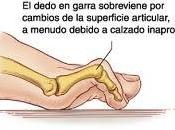 Soluciones deformidades dedos