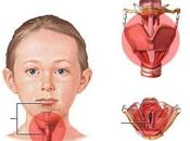 Laringitis aguda