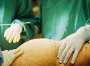 liposucción puede causar formación grasa visceral