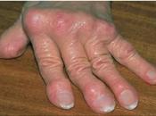 Muchas personas padecen artritis reumatoide España