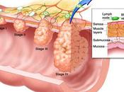 leche protegería progresión cáncer colon