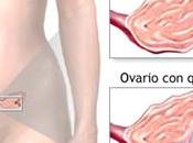 Cáncer ovario síntomas generales