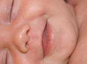 bebés tienen dermatitis atópica riesgo desarrollar alergia látex