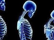 Cómo prevenir osteoporosis forma temprana