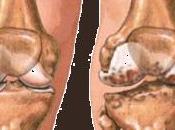 utilidad Pilates para casos artrosis rodilla