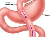 cirugía para perder peso disminuye riesgos cardiacos