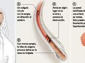isquemia cerebral.