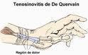 Tendinitis Quervain