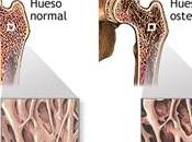 Osteoporosis