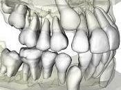 ¿Ortodoncia, dientes chuecos, maloclusion? Dudas respuestas