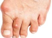 Aproximación genética gota