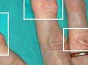 Artritis Aceites Hechos Base Maíz