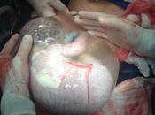 Parto velado: nacimiento bebés saco amniótico intacto
