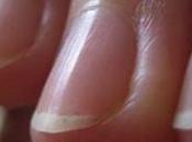 Uñas Diagnóstico Enfermedades