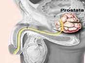 Cómo diagnosticar cáncer próstata cómo tratarlo