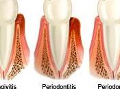 encías sangran, ¿tengo gingivitis?