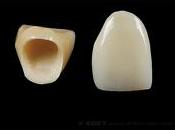 ☻proteger reparar dientes rotos fragiles.