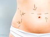 Abdominoplastia contra flacidez abdomen
