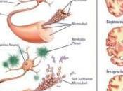 tratamiento prometedor para enfermedad Alzheimer