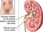 ¿Qué cálculos renales?