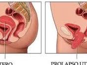 prolapso