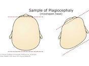 plagiocefalia postural bebé cada frecuente porque padres unos cagados para cambiarlos posición
