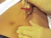 Carboxiterapia