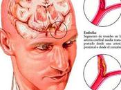 Como reconocer embolia cerebral