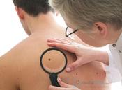 Cáncer piel: melanoma
