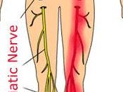 Ciencia Vida: Como calmar forma natural dolor Ciática