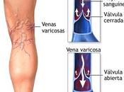 ¿Qué molestas varices cúal tratamiento?