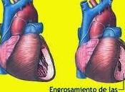 Hipertensión Deporte