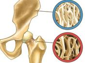 Consejos para evitar Osteoporosis