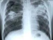 Nuevo Test Diagnostica Tuberculosis horas