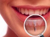 cosas debe saber acerca implantes dentales