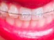 braces brackets Implante coclear