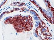familia genes clave contra cáncer próstata