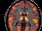 neuroimagen detecta Parkinson pacientes trastornos sueño