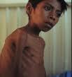 Detalles importantes sobre tuberculosis